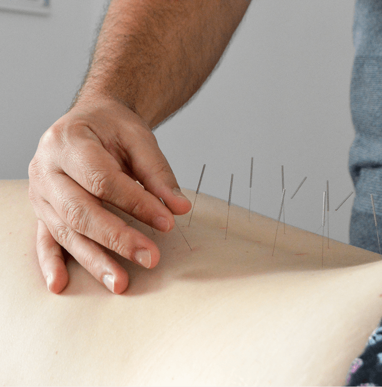 Dry needling treatment by physical therapist at Fort Lee PT in Fort Lee NJ